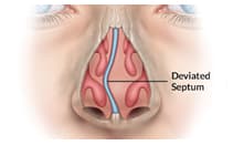 SleepFacts_EckCreativeMedia_Deviated_Sptum