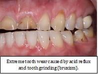 SleepFacts_EckCreativeMedia_Design_Extreme_Tooth_Wear