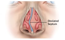 SleepFacts_EckCreativeMedia_Deviated_Sptum