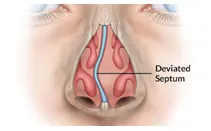 SleepFacts_EckCreativeMedia_Deviated_Sptum