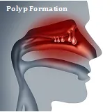 SleepFacts_EckCreativeMedia_Polyp_Formation