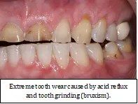 SleepFacts_EckCreativeMedia_Design_Extreme_Tooth_Wear